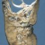 Cystic nephroma