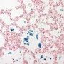 Pulmonary hemosiderosis (emcephalopathy with recurrent aspirations)