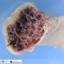 Osteochondroma
