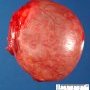 Ovarian serous cystadenoma