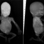 Caudal regression syndrome with lombosacral agenesis