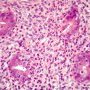 Acute colonic cryptitis in Crohn disease