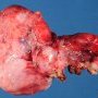 Ovarian luteal cyst