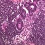 Epithelial tubes and undifferentated blastema in Wilms tumor