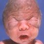 Pfeiffer syndrome