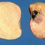 Ovarian fibrothecoma