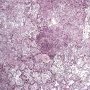 Acute pneumonia in bacterial pneumonia