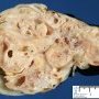 Intra-abdominal immature teratoma