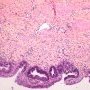 Biliary epithelial dysplasia in choledochal cyst