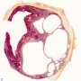 Hepatic mesothelial cysts