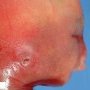 Microtia in trisomy 13