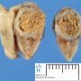 Fecalith and acute apendicitis
