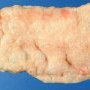 Colonic pneumatosis in infectious colitis