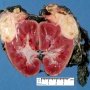Wilms tumor