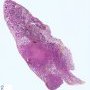Pulmonary nodule in lymphomatoid granulomatosis