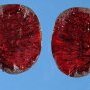Testicular hemorrhagic necrosis in testicular torsion