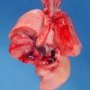 Esophageal atresia with tracheoesophageal fistula