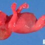 Cystic hygroma in Turner syndrome (18 weeks)