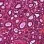Pancreatic acinar cell carcinoma
