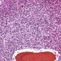 Bone marrow localization of classic Hodgkin lymphoma