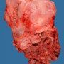 Placenta percreta (08)