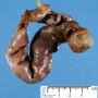 Intestinal invagination and perforative necrosis on Meckel diverticula