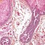 Hidrocystoma