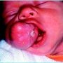 Neonatal epulis