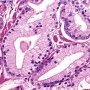 Gleason Pattern 3 - Large variant (WebPathology)