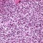 Bone marrow localization of classic Hodgkin lymphoma