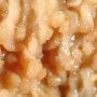 Ileal lymphoid polyps
