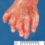 Postaxial polydactyly in trisomy 13