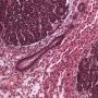 Blastemal component in Wilms tumor