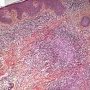 Dermal epithelioid granulomas