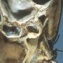 Cystic nephroma
