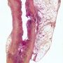 Acute appendicitis