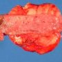 Mesenteric lipoma
