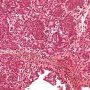 Acute bronchopneumonia