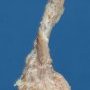 Testicular hypoplasia in cryptorchidism