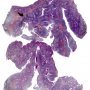 Adenoids