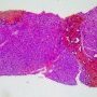 Ductal plate malformation (congenital hepatic fibrosis)