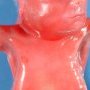 Upper limb pterygia