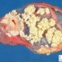 Ovarian dermoid cyst