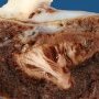 Old focal placental infarct