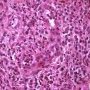 Acute inflammation with granulocytic diapedesis in ileal Crohn (...)