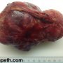 Thymoma, type A