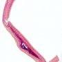 Aortic dissection in Marfan disease