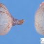 Cystic vesicular appendage of epoophoron