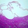 Renal cortical cysts