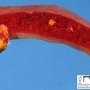 Hodgkin lymphoma invasion of the spleen